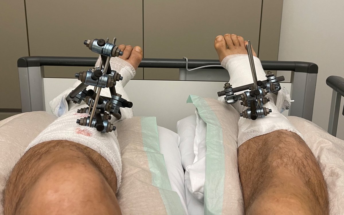 External fixators on both legs