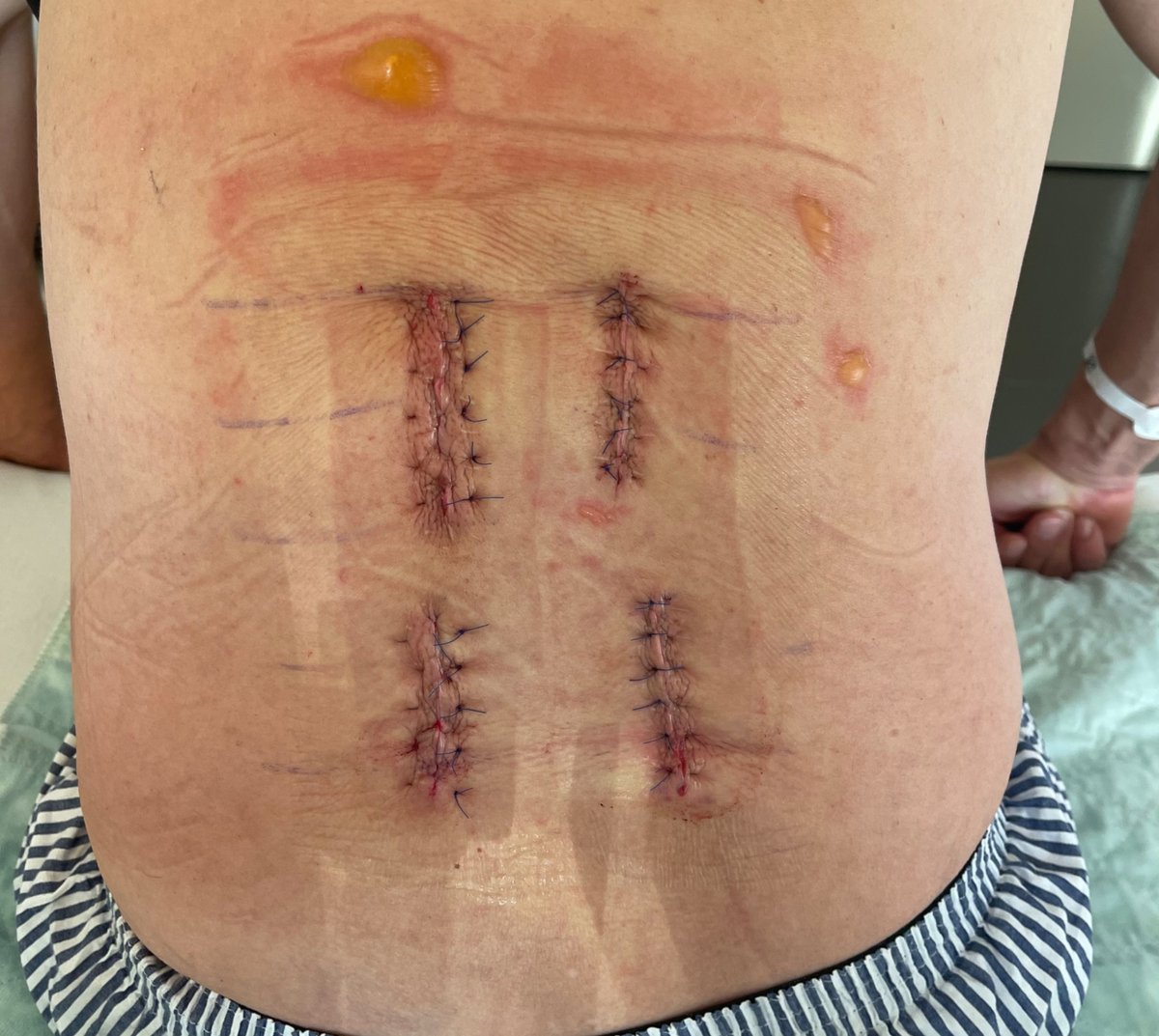 Surgical sutures after vertebral stabilisation