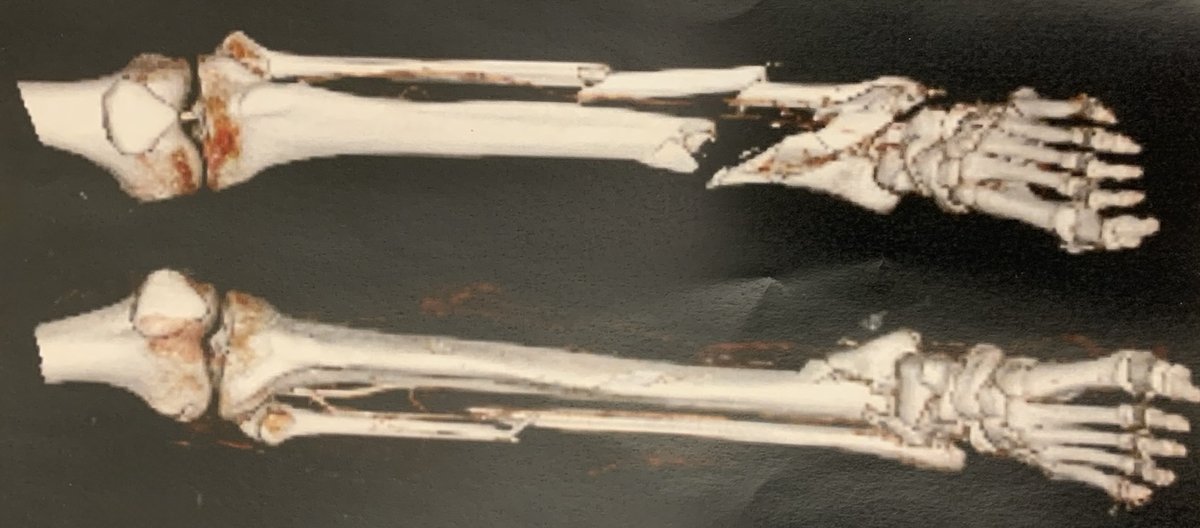 CT scan — 3D reconstruction of fractured tibia and fibula